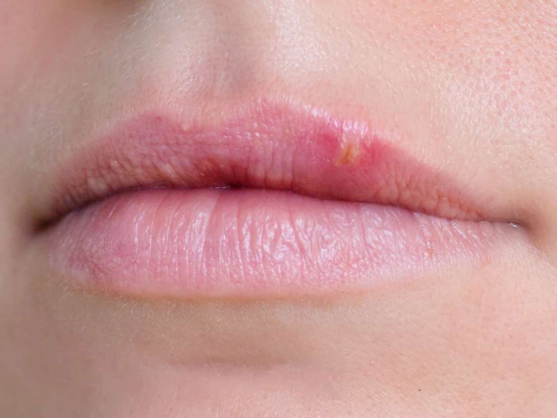 10 Strange Signs Youre Having An Allergic Reaction Page 5 Healthy